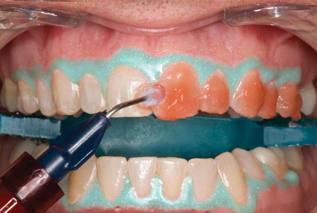 Opalescence-Boost-Procedure_Step-6 Opalescence-Boost-Procedure_Step-6
